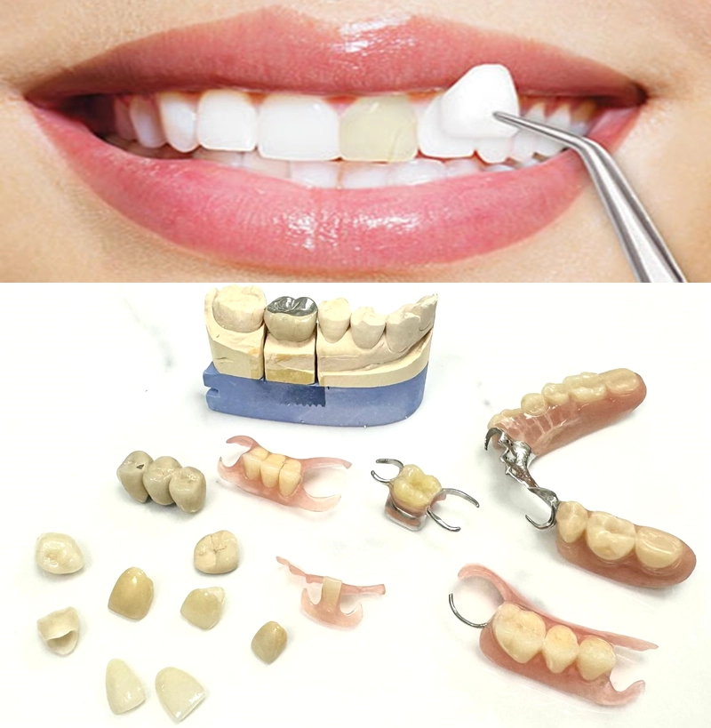 牙齒修復（牙貼片/牙套/牙橋/活動牙托）