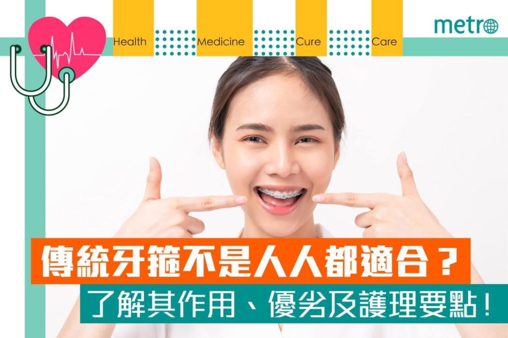 《Metro》報導：傳統牙箍不是人人都適合？了解其作用、優劣及護理要點！